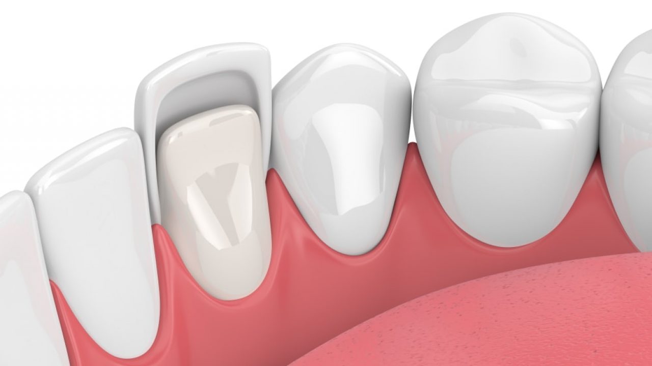 Facettes Dentaires centre dentaire dentilay