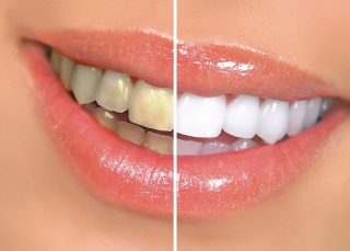 tabagisme et dents Centre dentaire Dentilay