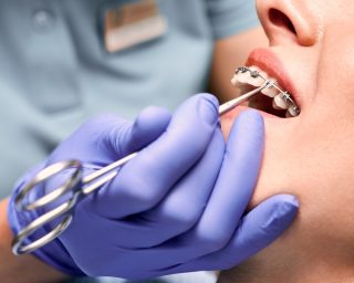 appareils orthodontique fixe