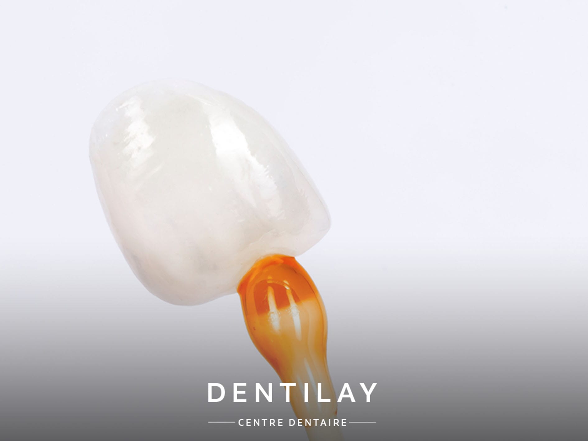 Quelle est la différence entre facette dentaire et couronne ?, Dr Elhyani