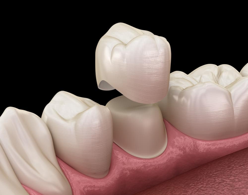 Quelle est la différence entre facette dentaire et couronne porcelaine ?