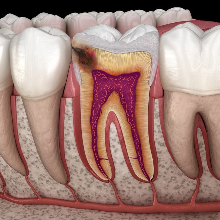 La carie dentaire Tout savoir sur les caries — free download