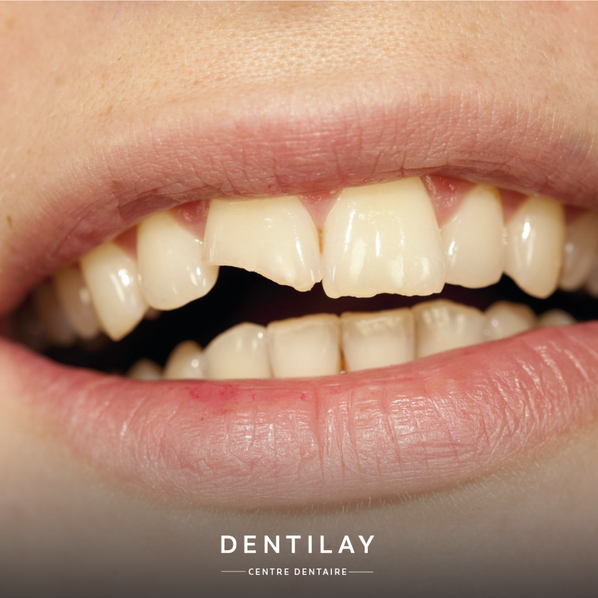Dent cassee Solution et réparation Dentilay
